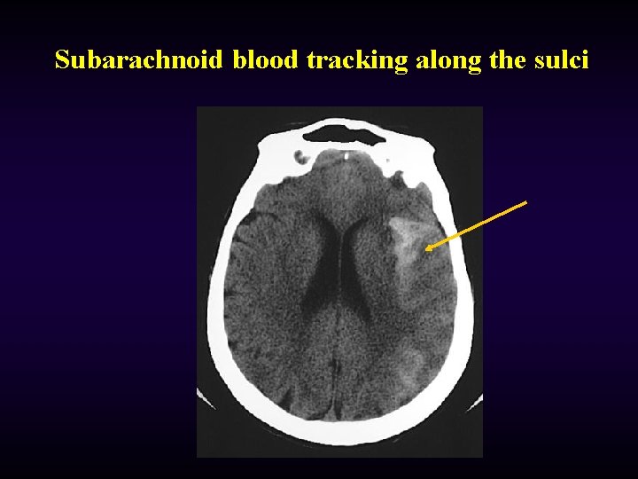 Subarachnoid blood tracking along the sulci 