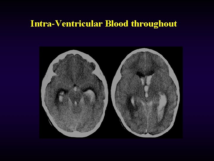 Intra-Ventricular Blood throughout 
