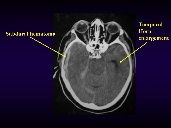 Subdural hematoma Temporal Horn enlargement 