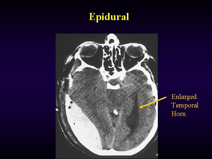 Epidural Enlarged Temporal Horn 