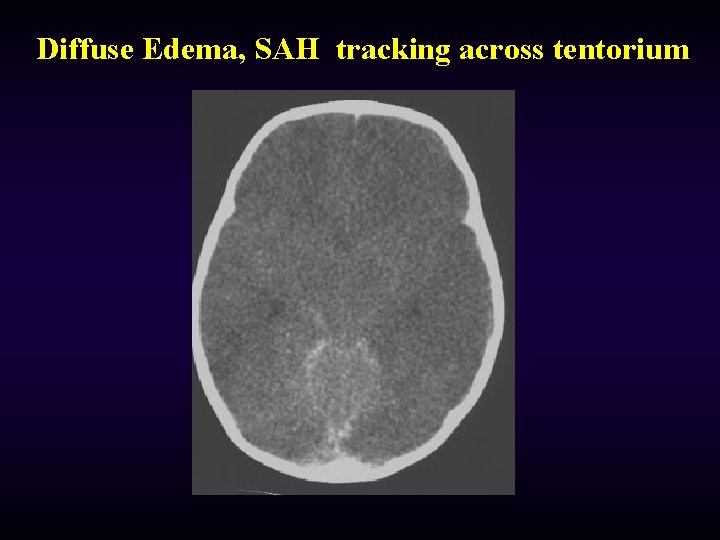 Diffuse Edema, SAH tracking across tentorium 