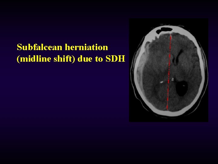 Subfalcean herniation (midline shift) due to SDH 