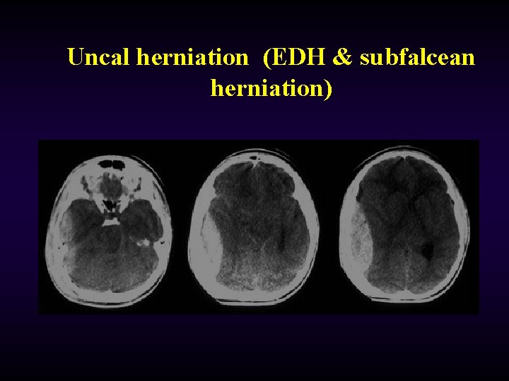 Uncal herniation (EDH & subfalcean herniation) 