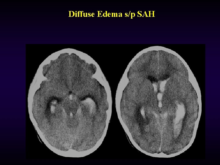 Diffuse Edema s/p SAH 