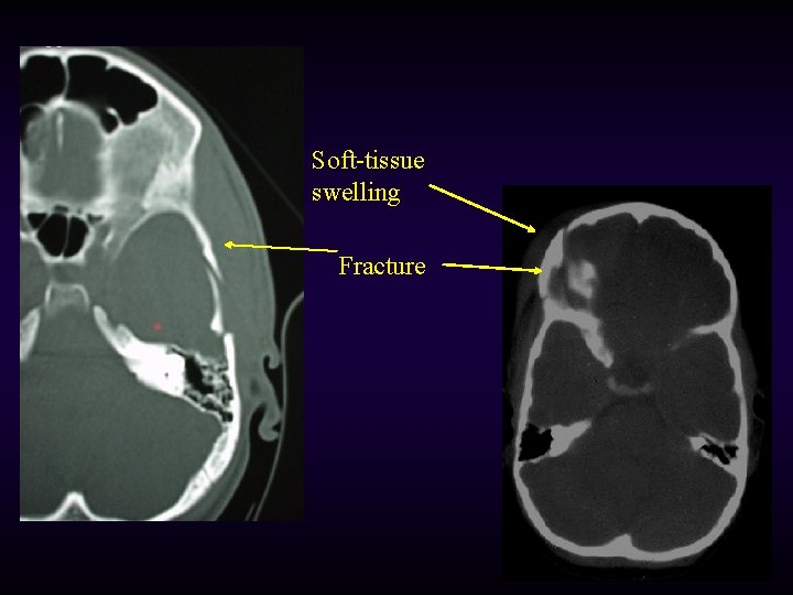 Soft-tissue swelling Fracture 