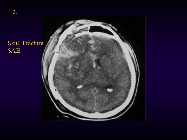 2. Skull Fracture SAH 