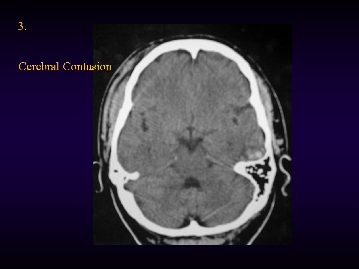 3. Cerebral Contusion 