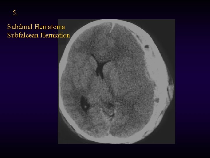 5. Subdural Hematoma Subfalcean Herniation 