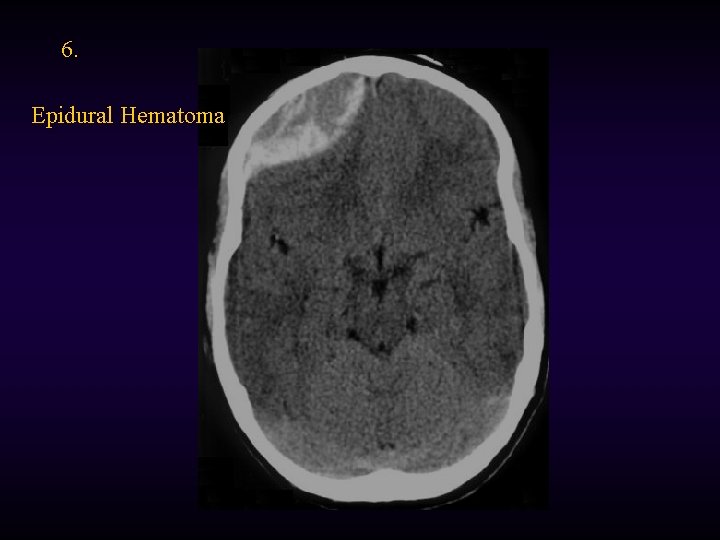 6. Epidural Hematoma 