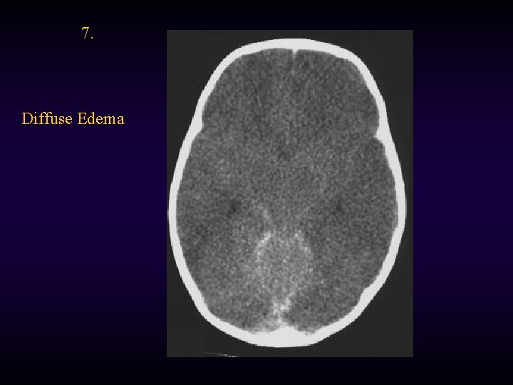 7. Diffuse Edema 
