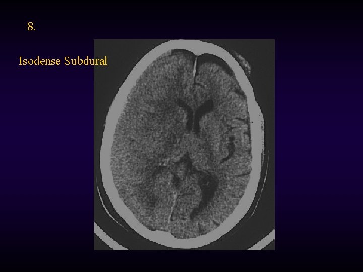 8. Isodense Subdural 