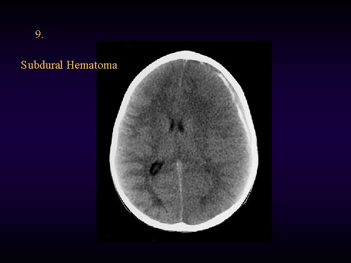 9. Subdural Hematoma 