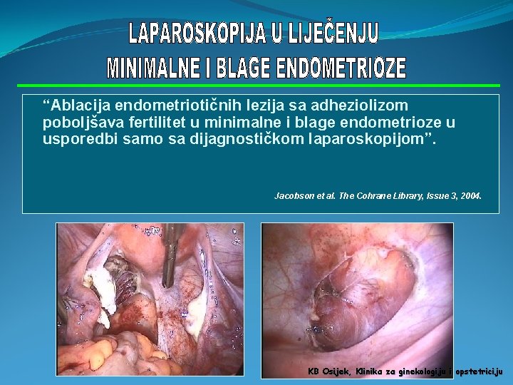 “Ablacija endometriotičnih lezija sa adheziolizom poboljšava fertilitet u minimalne i blage endometrioze u usporedbi