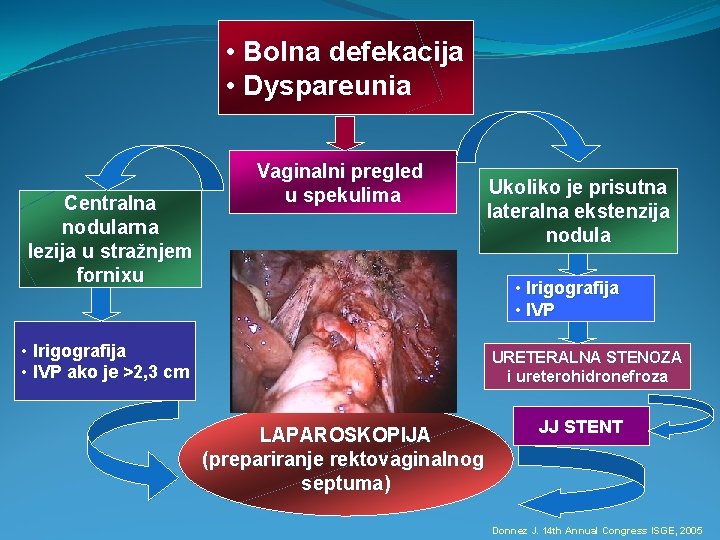  • Bolna defekacija • Dyspareunia Centralna nodularna lezija u stražnjem fornixu Vaginalni pregled