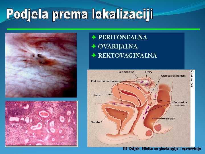  PERITONEALNA OVARIJALNA REKTOVAGINALNA KB Osijek, Klinika za ginekologiju i opstetriciju 