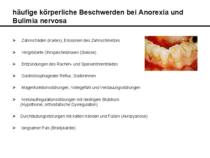 häufige körperliche Beschwerden bei Anorexia und Bulimia nervosa Ø Zahnschäden (Karies), Erosionen des Zahnschmelzes