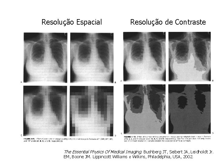 Resolução Espacial Resolução de Contraste The Essential Physics Of Medical Imaging. Bushberg JT, Seibert