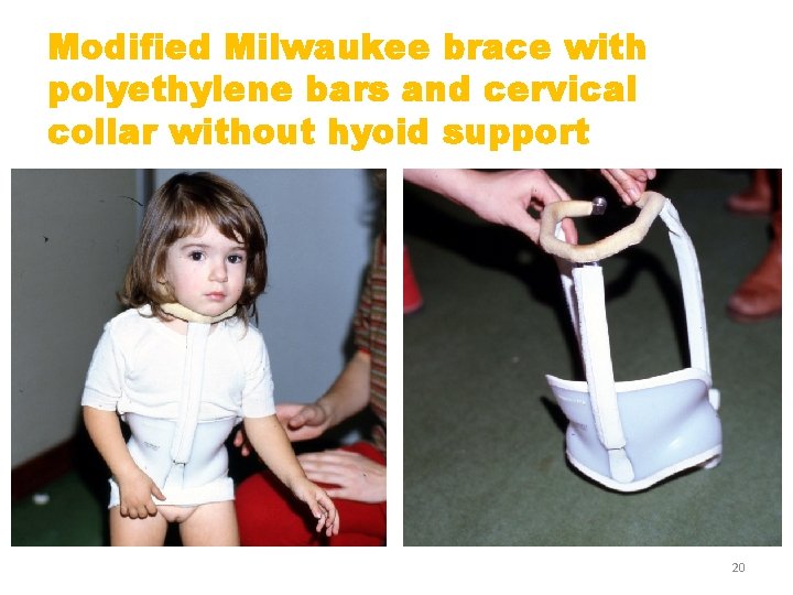 Modified Milwaukee brace with polyethylene bars and cervical collar without hyoid support 20 