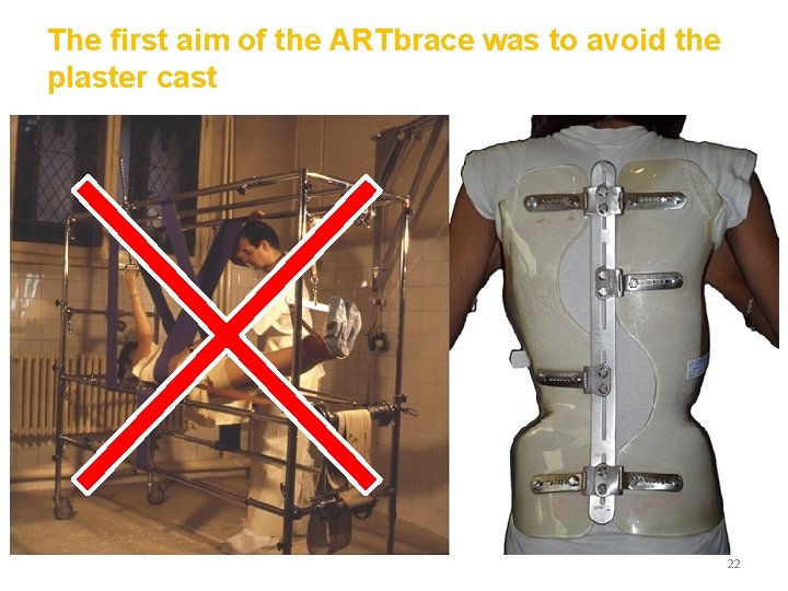 The first aim of the ARTbrace was to avoid the plaster cast 22 