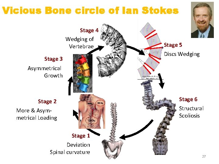 Vicious Bone circle of Ian Stokes Stage 4 Wedging of Vertebrae Stage 3 Stage