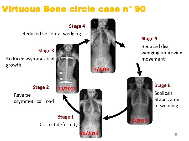 Virtuous Bone circle case n° 90 Stage 4 Reduced vertebral wedging Stage 5 Reduced