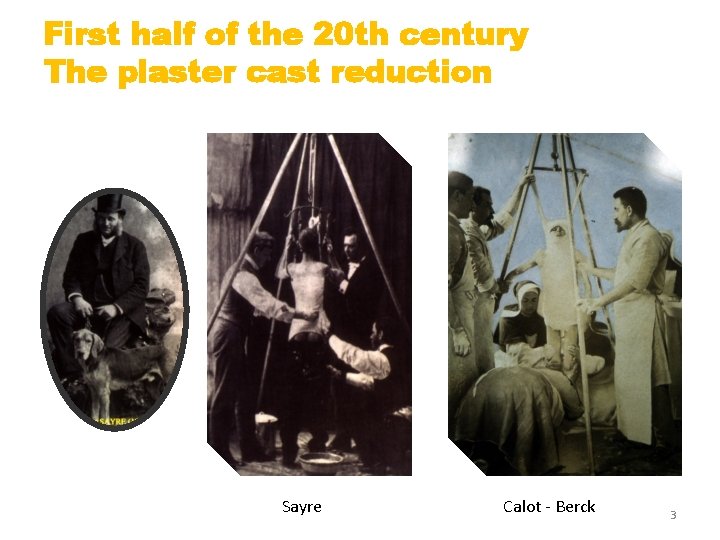 First half of the 20 th century The plaster cast reduction Sayre Calot -