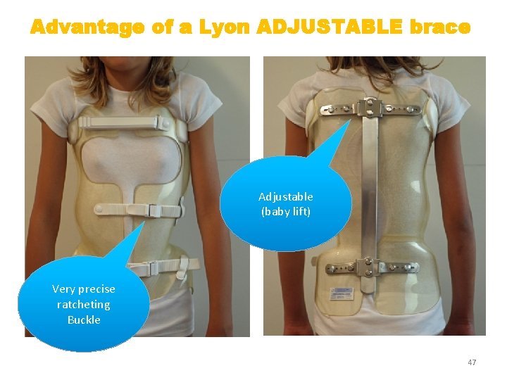 Advantage of a Lyon ADJUSTABLE brace Adjustable (baby lift) Very precise ratcheting Buckle 47