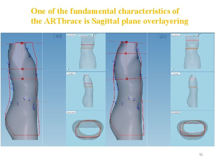 One of the fundamental characteristics of the ARTbrace is Sagittal plane overlayering 51 