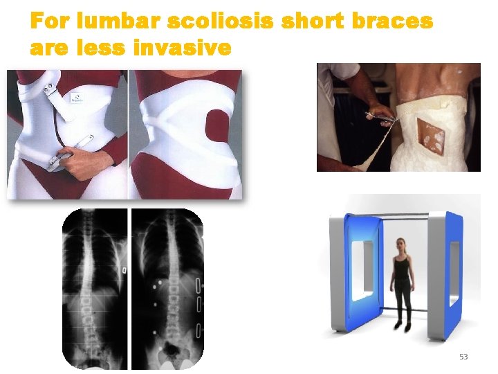 For lumbar scoliosis short braces are less invasive 53 