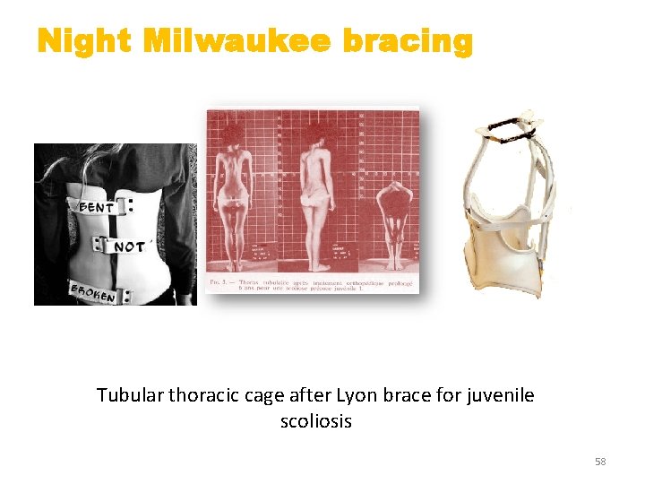 Night Milwaukee bracing Tubular thoracic cage after Lyon brace for juvenile scoliosis 58 