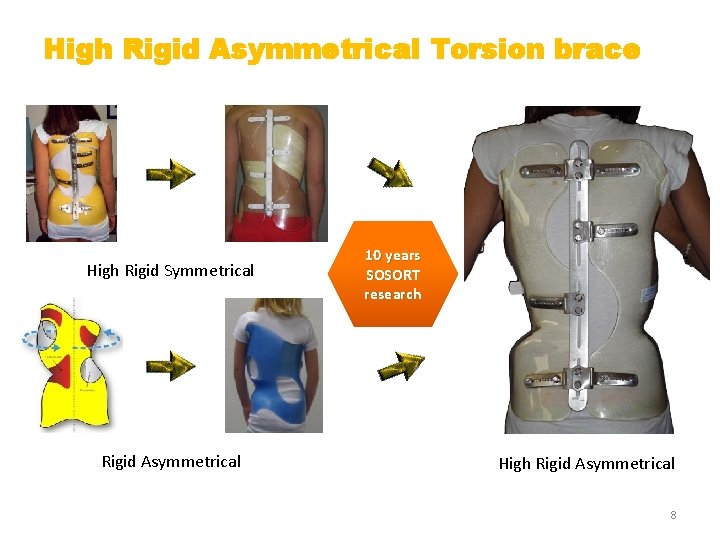 High Rigid Asymmetrical Torsion brace High Rigid Symmetrical Rigid Asymmetrical 10 years SOSORT research