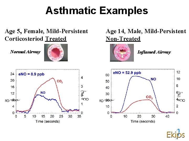 Asthmatic Examples Age 5, Female, Mild-Persistent Corticosteriod Treated Normal Airway Age 14, Male, Mild-Persistent