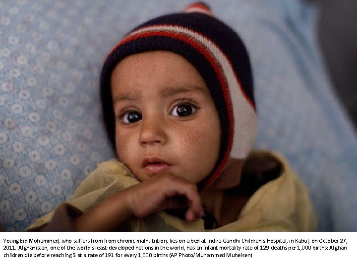 Young Eid Mohammed, who suffers from chronic malnutrition, lies on a bed at Indira