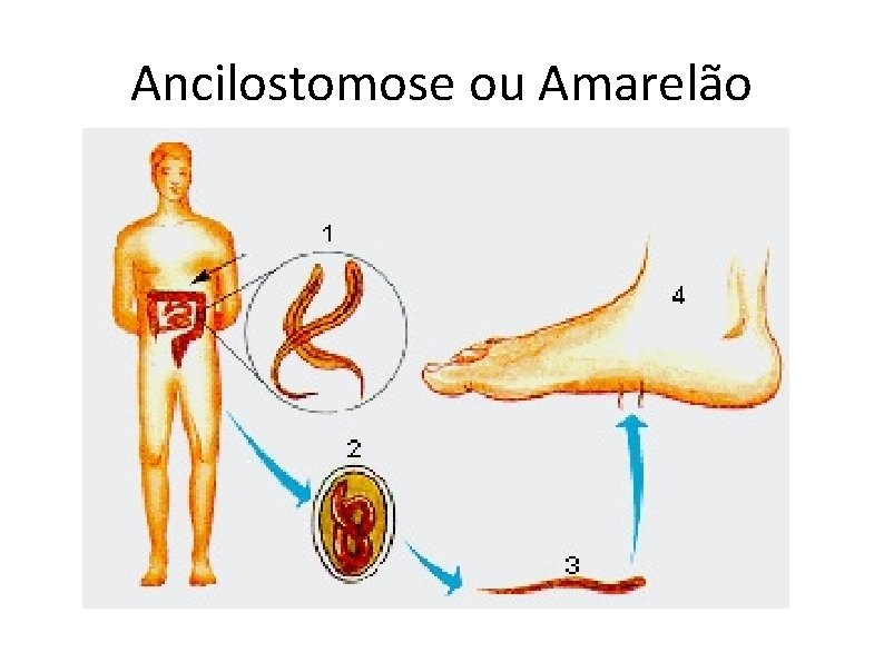 Ancilostomose ou Amarelão 