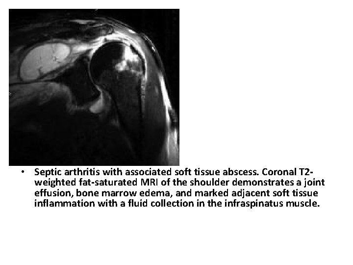  • Septic arthritis with associated soft tissue abscess. Coronal T 2 weighted fat-saturated