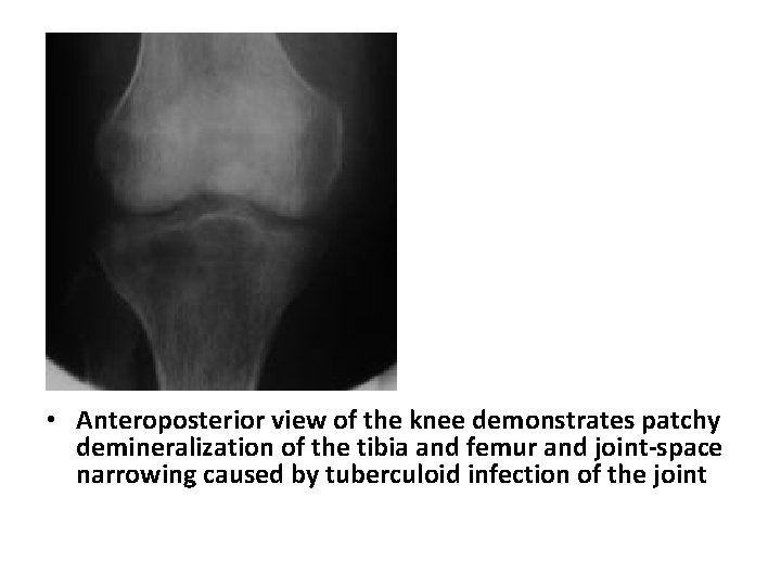  • Anteroposterior view of the knee demonstrates patchy demineralization of the tibia and