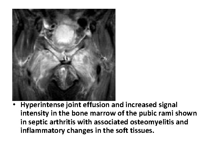  • Hyperintense joint effusion and increased signal intensity in the bone marrow of