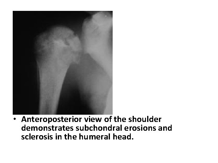  • Anteroposterior view of the shoulder demonstrates subchondral erosions and sclerosis in the