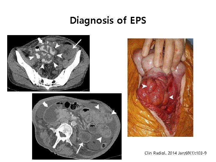 Diagnosis of EPS Clin Radiol. 2014 Jan; 69(1): 103 -9 