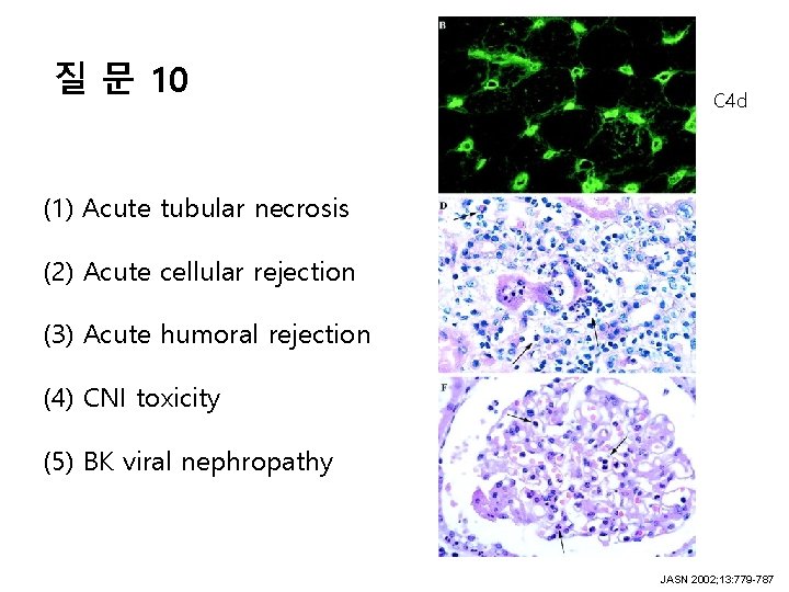질 문 10 C 4 d (1) Acute tubular necrosis (2) Acute cellular rejection