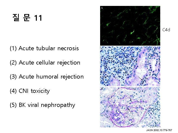 질 문 11 C 4 d (1) Acute tubular necrosis (2) Acute cellular rejection