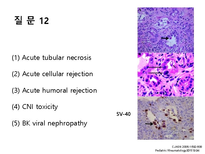 질 문 12 (1) Acute tubular necrosis (2) Acute cellular rejection (3) Acute humoral