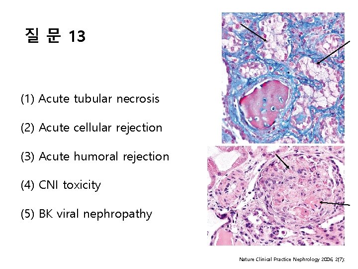 질 문 13 (1) Acute tubular necrosis (2) Acute cellular rejection (3) Acute humoral