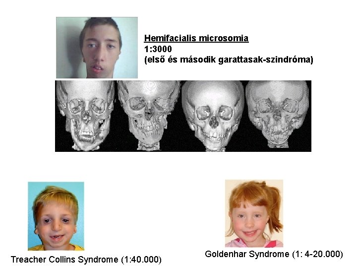 Hemifacialis microsomia 1: 3000 (első és második garattasak-szindróma) Treacher Collins Syndrome (1: 40. 000)