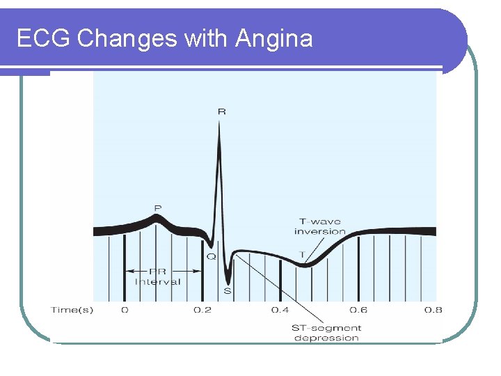 ECG Changes with Angina 