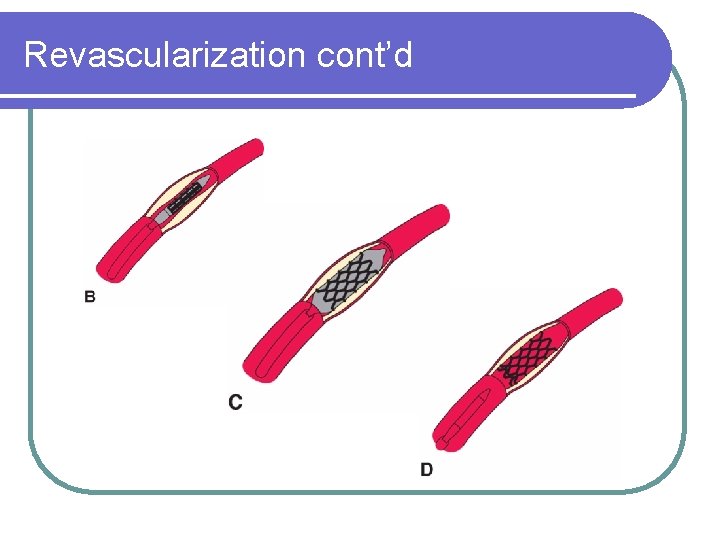 Revascularization cont’d 