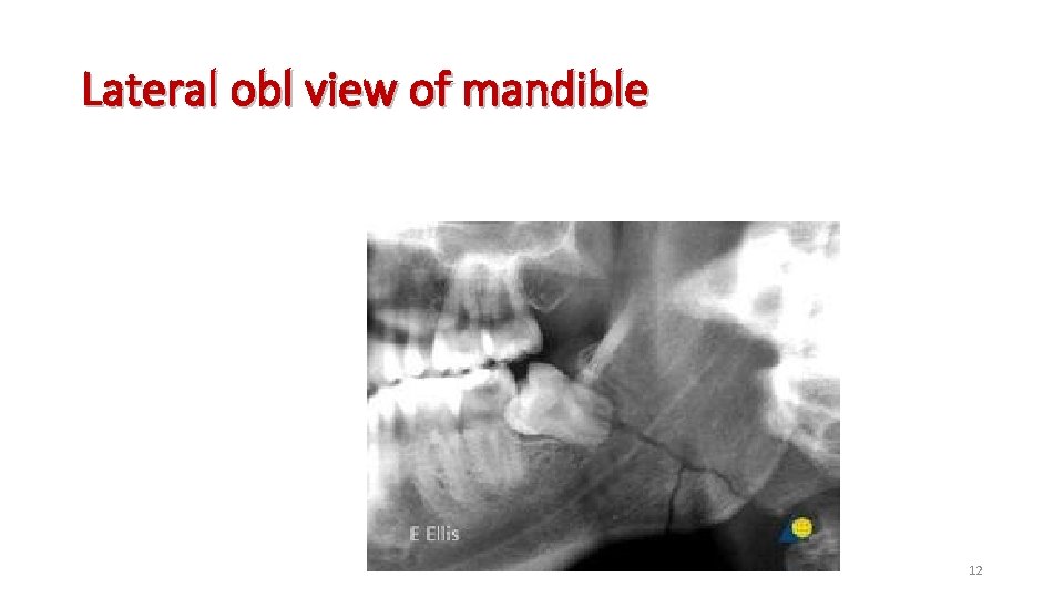 Lateral obl view of mandible 12 