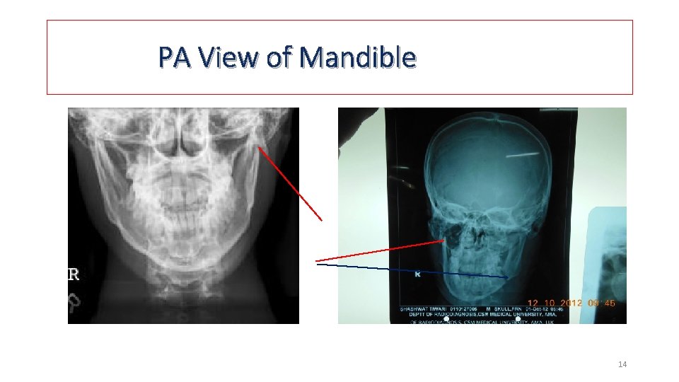PA View of Mandible 14 