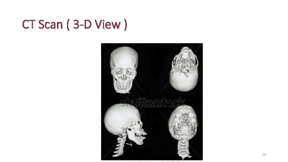 CT Scan ( 3 -D View ) 18 