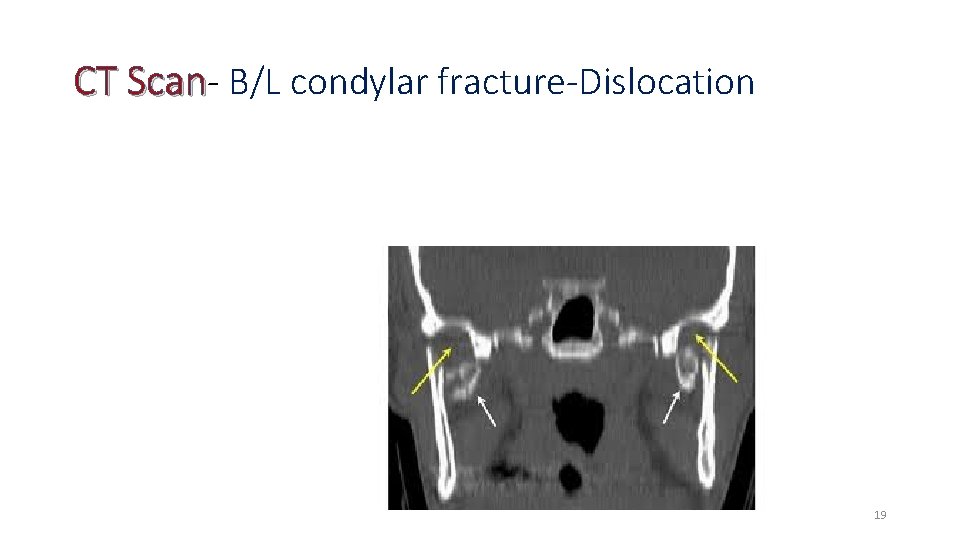 CT Scan- B/L condylar fracture-Dislocation 19 